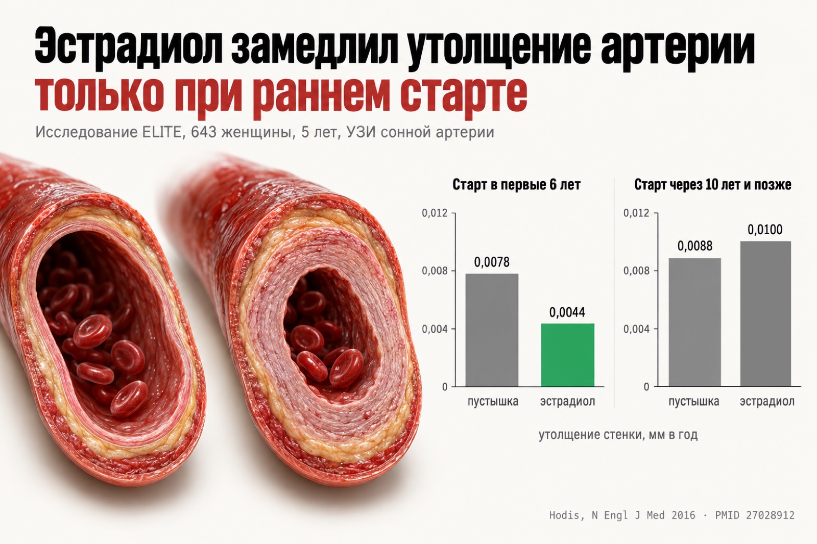 ELITE: эстрадиол замедлил утолщение стенки сонной артерии только при раннем старте